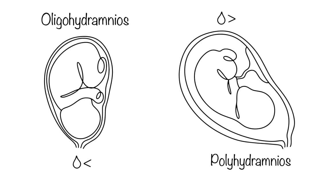 kako prepoznati curenje plodne vode