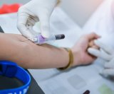 lipoprotein(a), poznat i kao Lp(a), može značajno povećati rizik od moždanog udara čak i kod osoba koje već primaju standardnu terapiju za kolesterol
