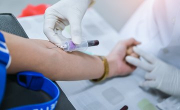lipoprotein(a), poznat i kao Lp(a), može značajno povećati rizik od moždanog udara čak i kod osoba koje već primaju standardnu terapiju za kolesterol