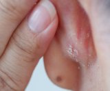 znakovi psorijaze ponekad mogu biti vrlo suptilni ili se pojaviti na neočekivanim mjestima