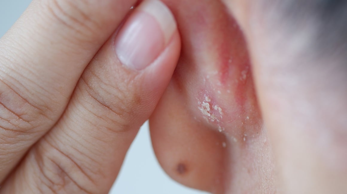 znakovi psorijaze ponekad mogu biti vrlo suptilni ili se pojaviti na neočekivanim mjestima