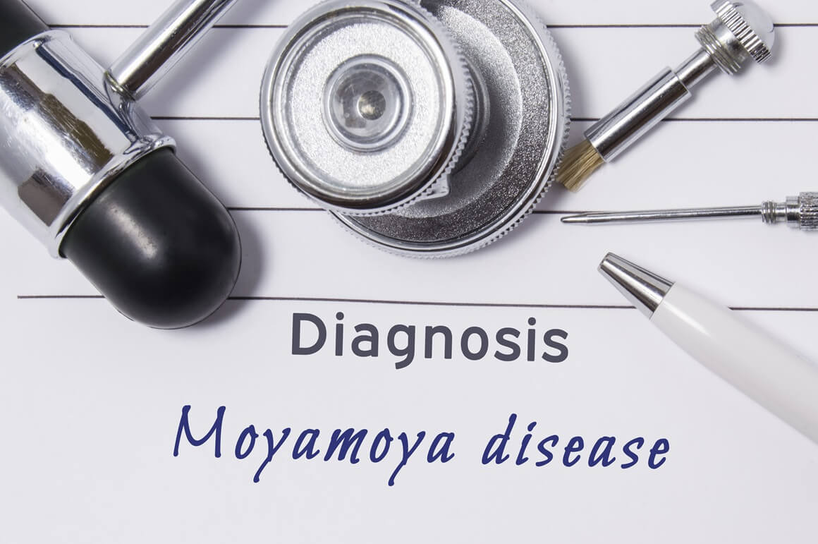 Moyamoya bolest
