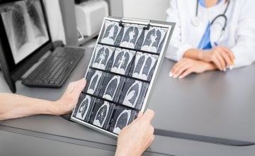 Oporavak nakon operacije raka pluća