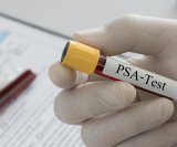 PSA test jedan je od najčešćih pregleda za procjenu zdravlja prostate kod muškaraca
