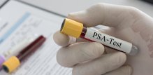 PSA test jedan je od najčešćih pregleda za procjenu zdravlja prostate kod muškaraca