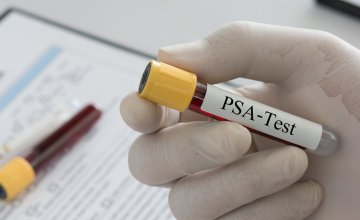 PSA test jedan je od najčešćih pregleda za procjenu zdravlja prostate kod muškaraca