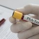 PSA test jedan je od najčešćih pregleda za procjenu zdravlja prostate kod muškaraca