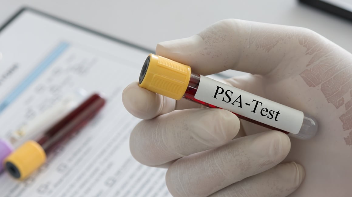 PSA test jedan je od najčešćih pregleda za procjenu zdravlja prostate kod muškaraca