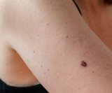 Prevencija melanoma
