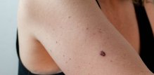 Prevencija melanoma