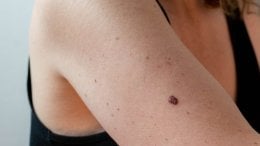 Prevencija melanoma