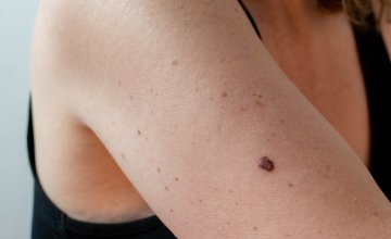 Prevencija melanoma