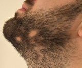 Alopecija brade