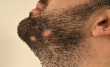 Alopecija brade