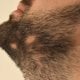 Alopecija brade