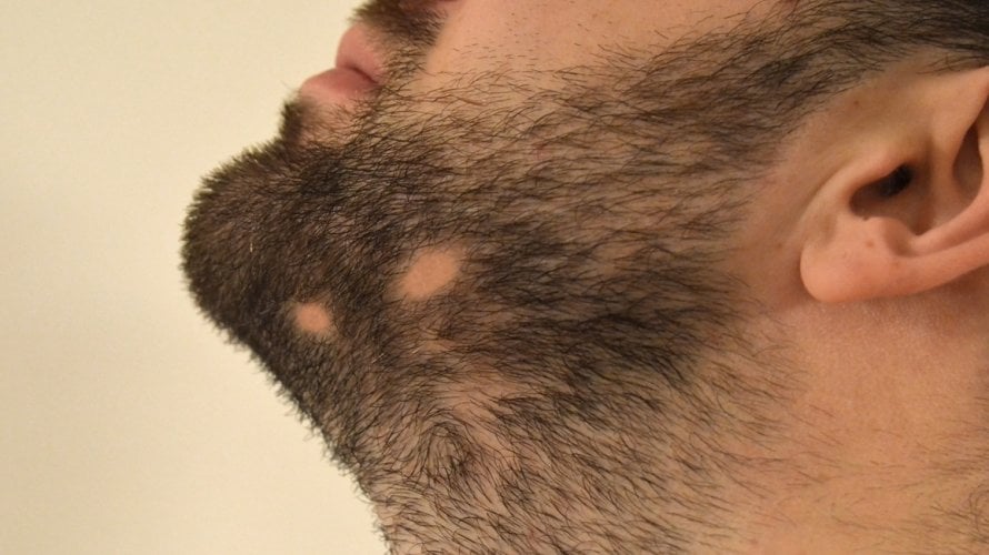 Alopecija brade
