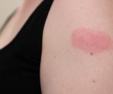 Atopijski dermatitis i cijepljenje