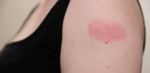 Atopijski dermatitis i cijepljenje