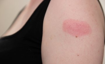 Atopijski dermatitis i cijepljenje