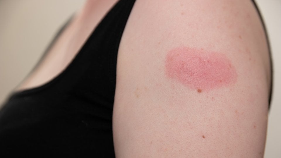 Atopijski dermatitis i cijepljenje