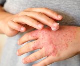 Najbolje kreme za kontaktni dermatitis