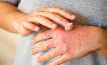 Najbolje kreme za kontaktni dermatitis