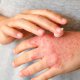 Najbolje kreme za kontaktni dermatitis
