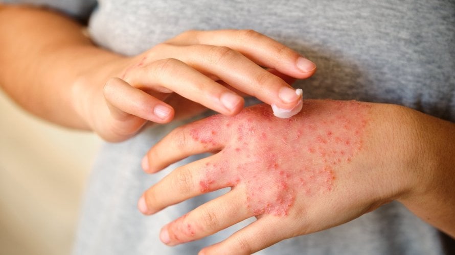 Najbolje kreme za kontaktni dermatitis