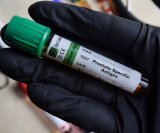 Novi test za rak prostate otkriva više opasnih slučajeva od PSA testa