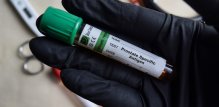 Novi test za rak prostate otkriva više opasnih slučajeva od PSA testa