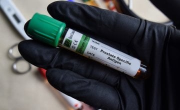 Novi test za rak prostate otkriva više opasnih slučajeva od PSA testa