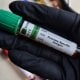 Novi test za rak prostate otkriva više opasnih slučajeva od PSA testa
