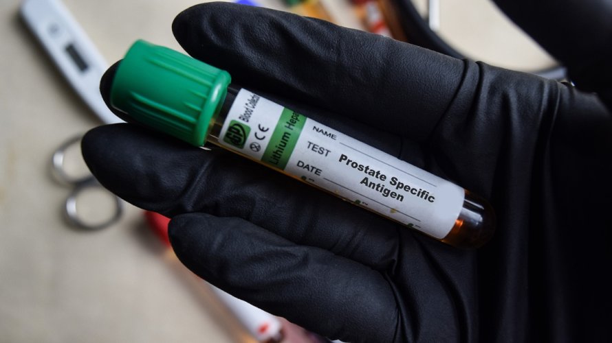 Novi test za rak prostate otkriva više opasnih slučajeva od PSA testa