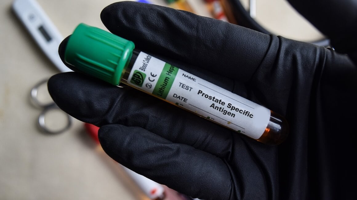 Novi test za rak prostate otkriva više opasnih slučajeva od PSA testa