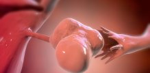 PMOS ne nestaje nakon menopauze