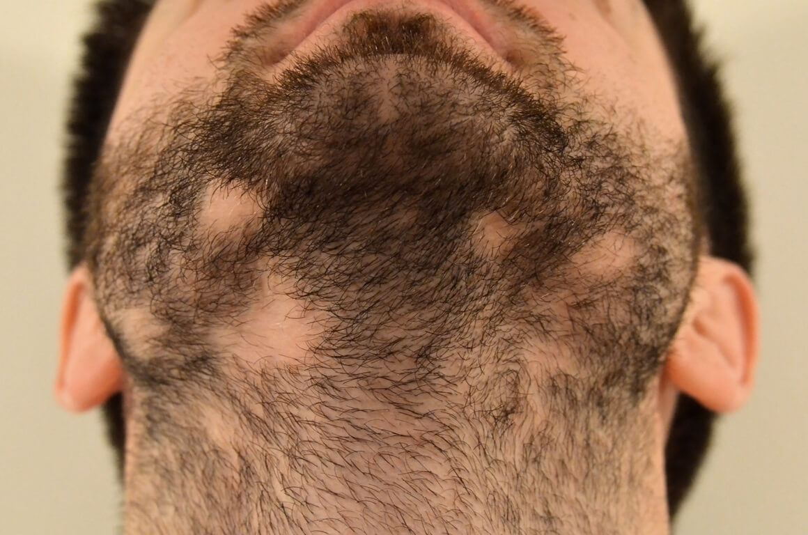alopecija brade - uzrok