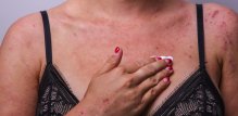 kontaktni dermatitis - prirodno liječenje