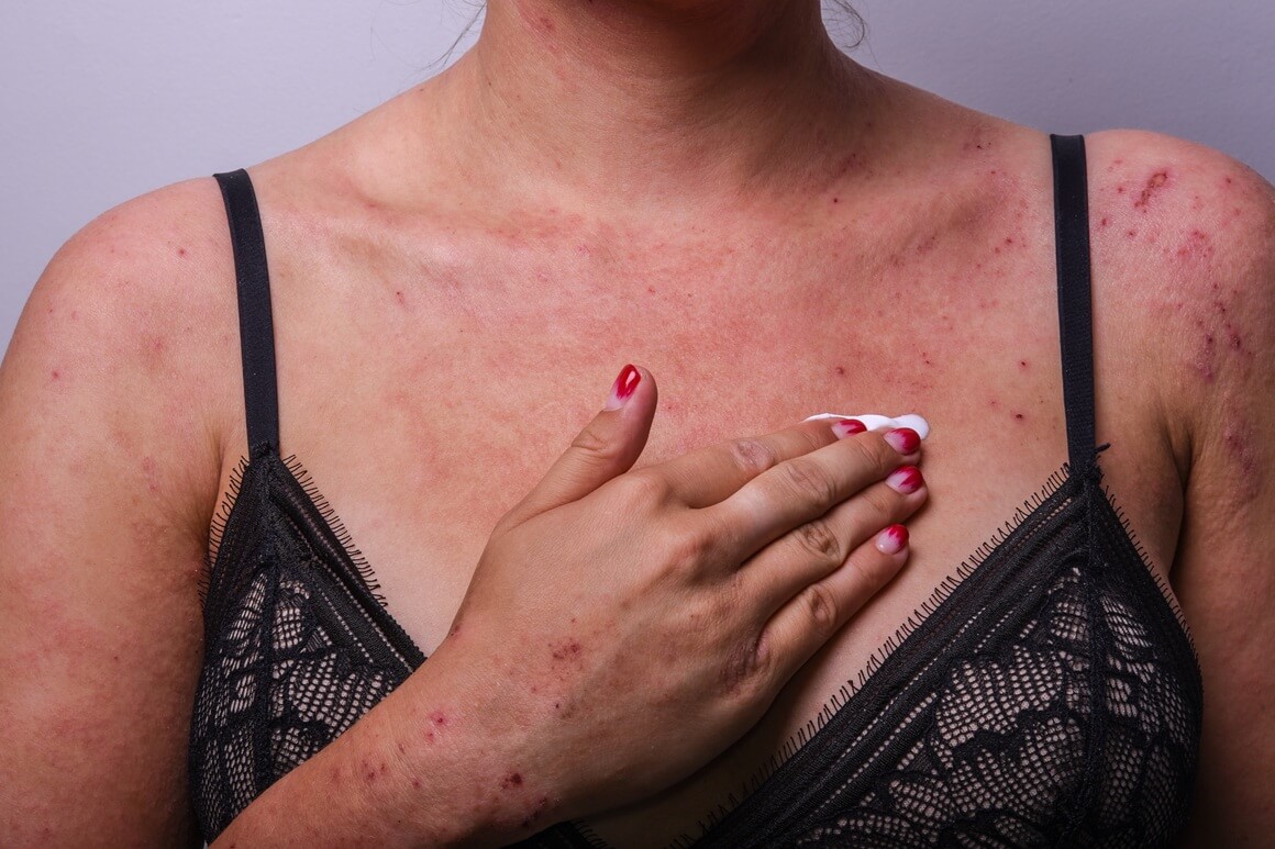 kontaktni dermatitis - prirodno liječenje