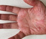 Palmoplantarna psorijaza