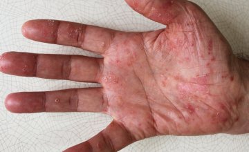 Palmoplantarna psorijaza