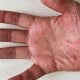 Palmoplantarna psorijaza