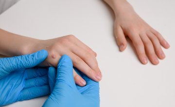 Virusne bradavice kod djece čest su problem